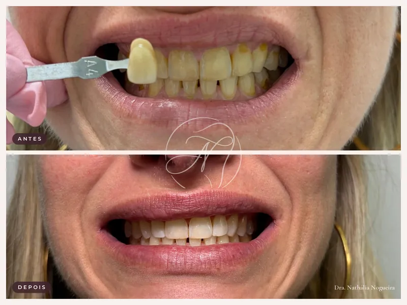 Antes e depois de limpeza e clareamento