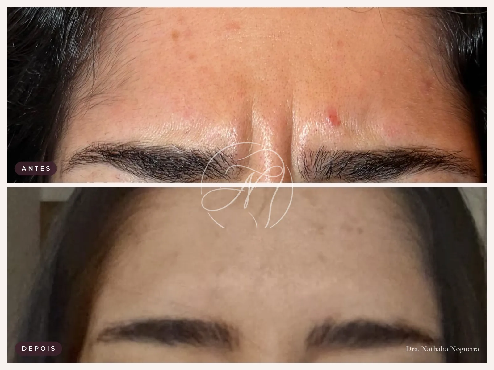 Antes e depois de toxina botulínica
