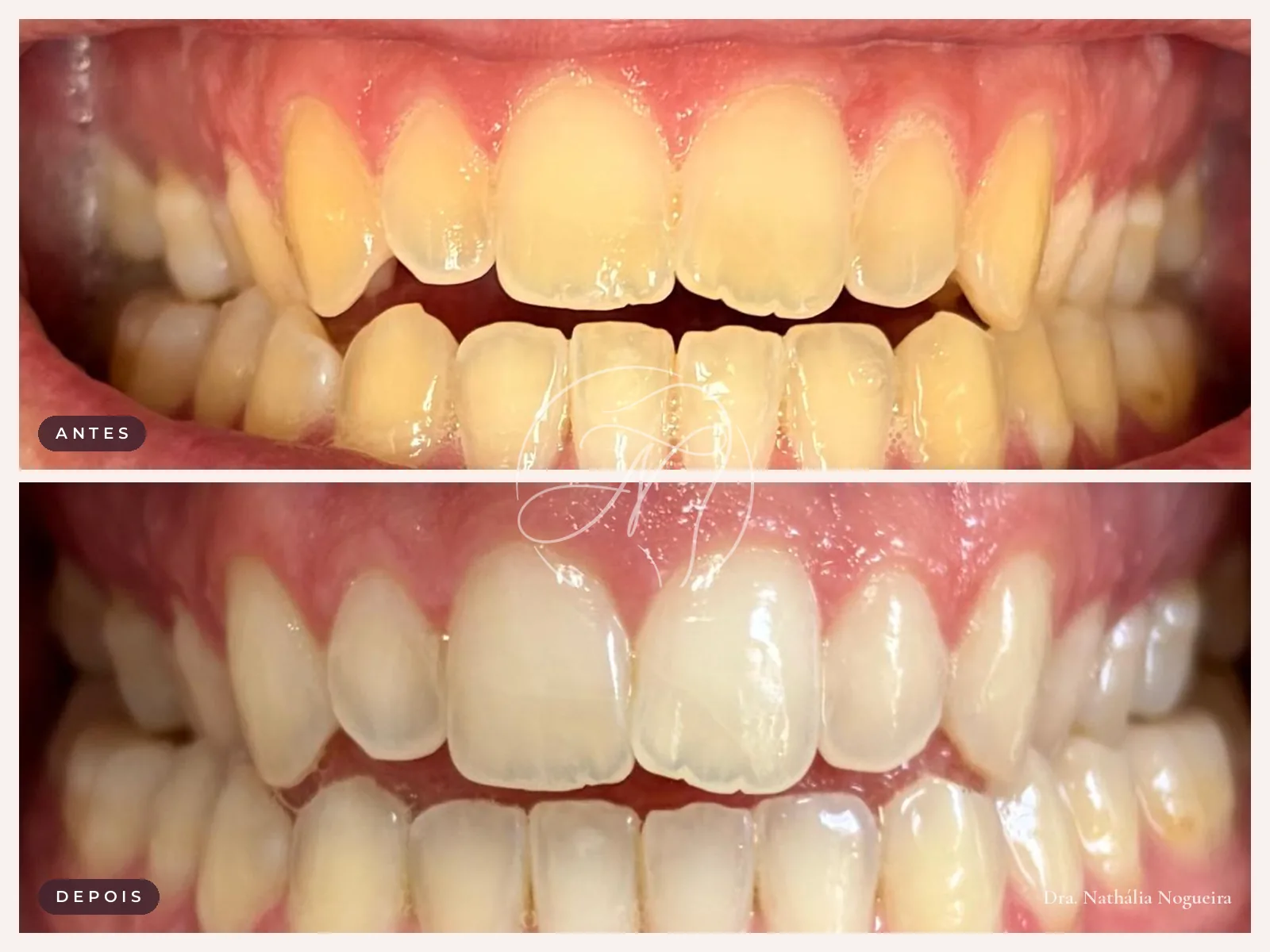 Antes e depois de clareamento dental