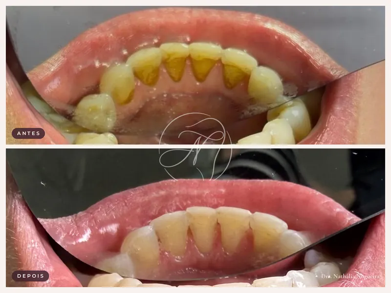 Antes e depois de limpeza dental