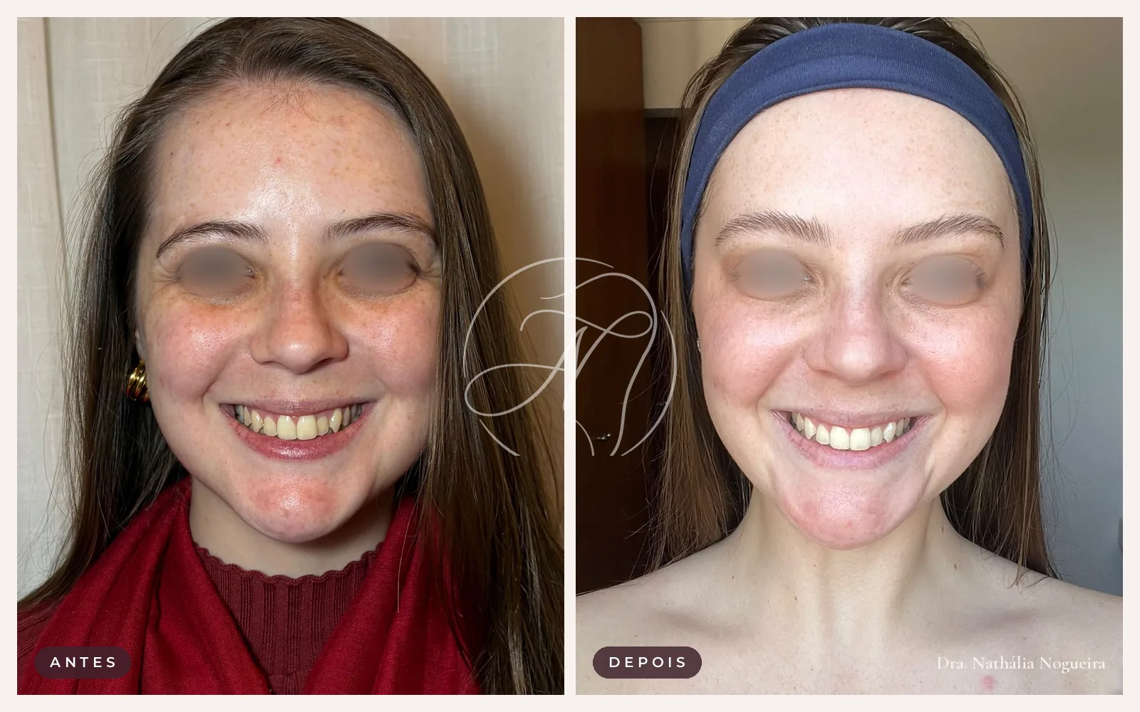 Antes e depois de toxina botulínica