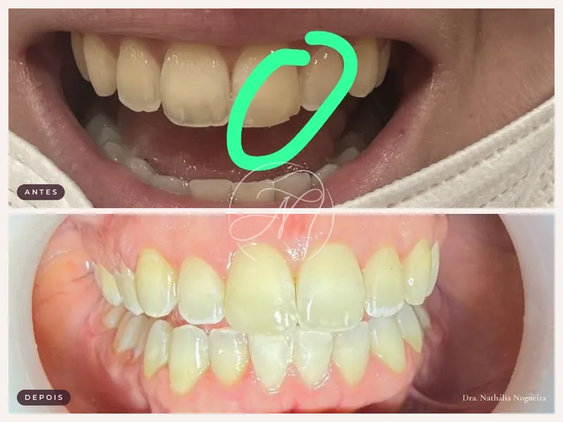 Antes e depois de restauração